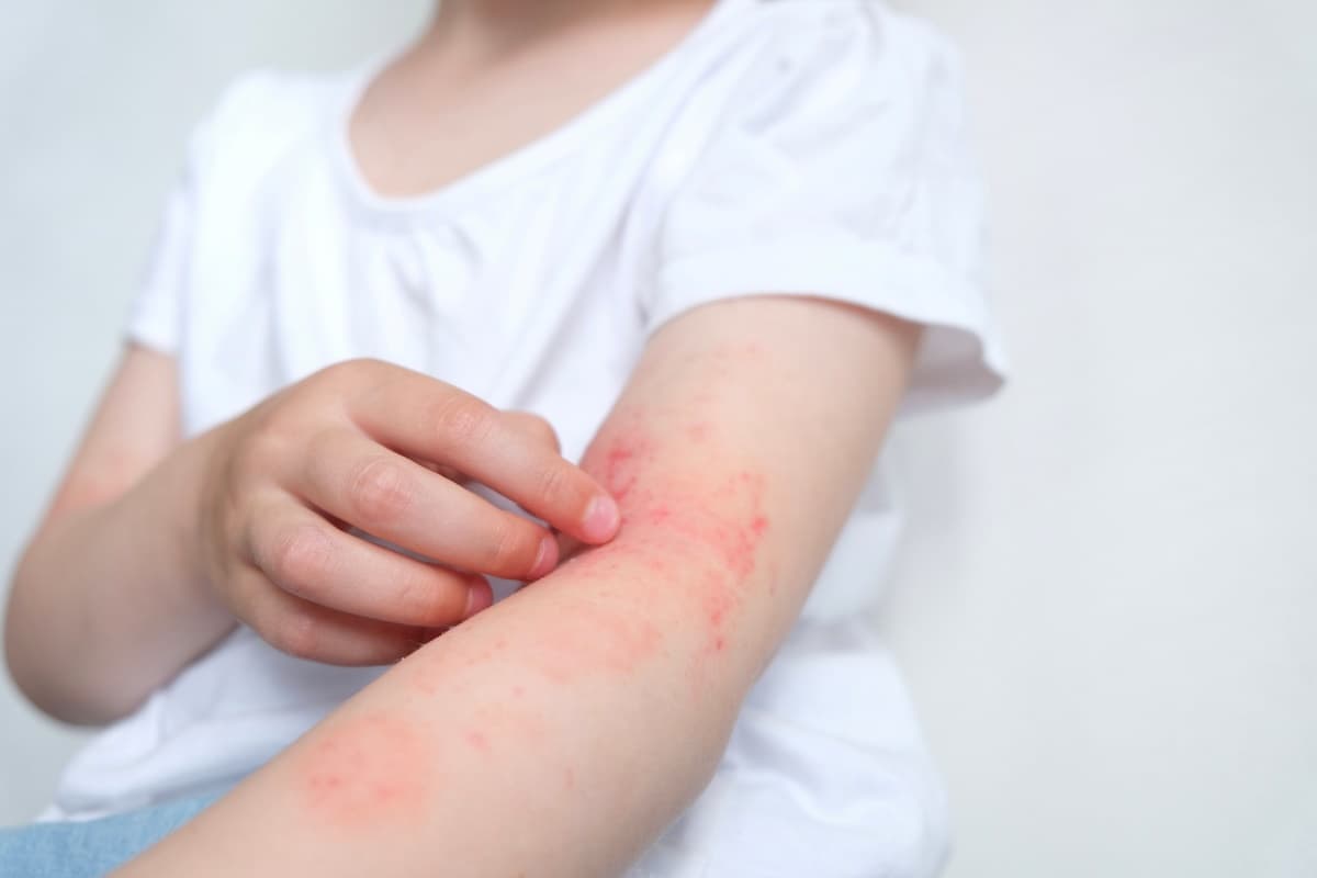 Egg Allergy Symptoms in Adults: Why You Suddenly React